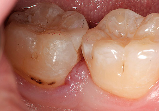 Se a condição dos dentes for claramente ruim, não adie a visita ao dentista, pois em casa você não pode se livrar do problema.