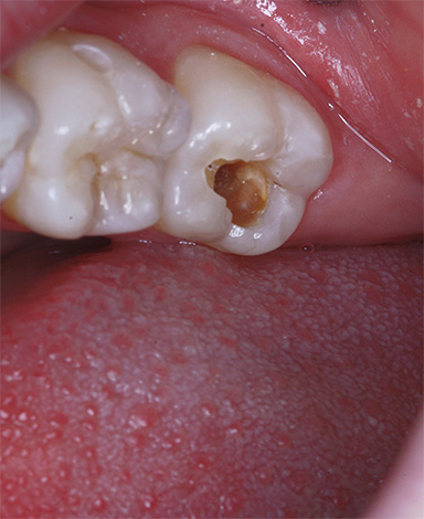 Na maioria dos casos, ao tentar raspar de maneira independente as áreas escuras do dente, a cavidade cariosa apenas se aprofunda e o risco de complicações aumenta ...