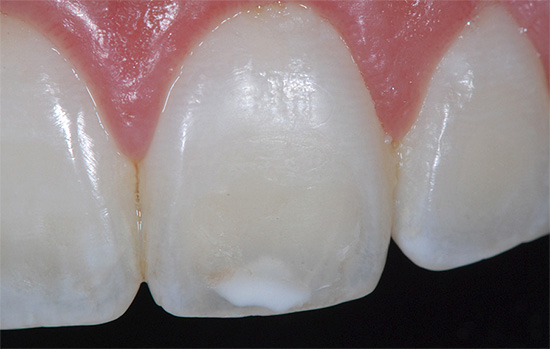 Mas na fase de uma mancha branca para restaurar as propriedades do esmalte dentário é bem possível não apenas no dentista, mas também em casa.