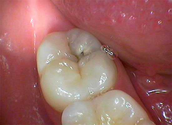 Mesmo manchas escuras insignificantes na superfície mastigatória do dente (na área da fissura) às vezes são uma espécie de orifício de entrada nas cavidades profundas da cárie, penetrando na camada de dentina ...
