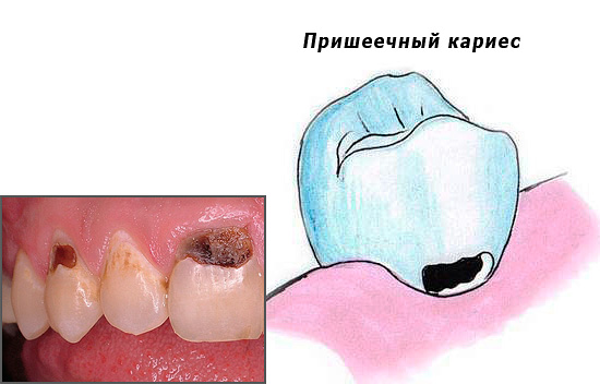 Vamos considerar algumas questões interessantes relacionadas ao tratamento da cárie cervical, incluindo terapia dentária e medidas que podem ser tomadas em casa.