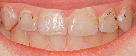 Infelizmente, não há garantias de que, ao fazer o tratamento você mesmo, você possa trazer os dentes de volta ao normal.