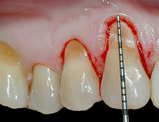 Um dos problemas no tratamento de defeitos cervicais é obter sangue das gengivas para o campo de trabalho.