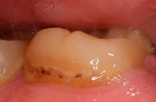Parece um dente com cárie cervical antes do tratamento