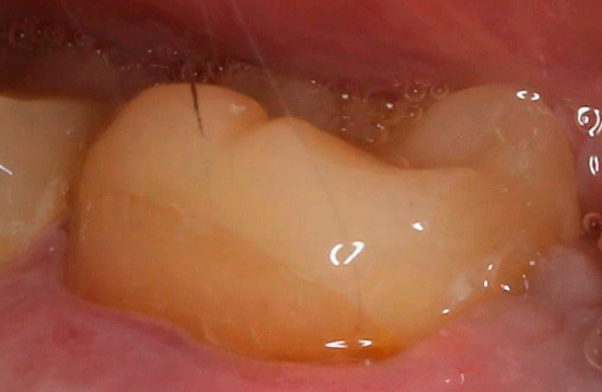E o mesmo dente parece após o tratamento, com uma vedação já instalada.