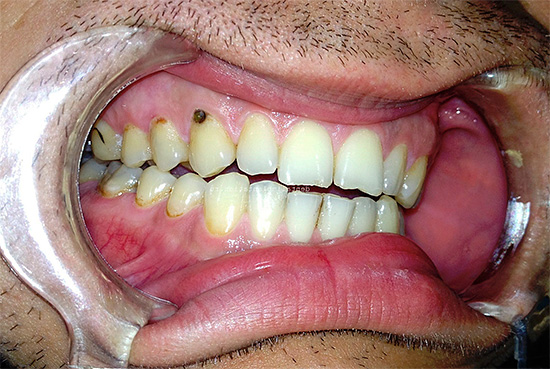 A foto mostra um exemplo de cárie cervical no dente superior