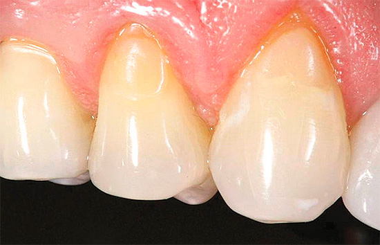 Dentes após tratamento de cárie cervical - os recheios são quase imperceptíveis