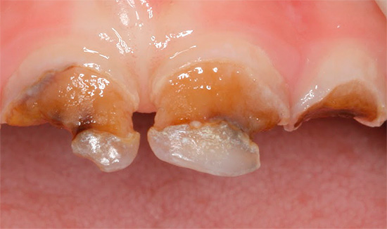 Com cáries circulares profundas, é possível fraturar a coroa do dente