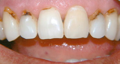 Quaisquer defeitos nos dentes da frente, para não mencionar a cárie cervical, estragam bastante a aparência da zona do sorriso.