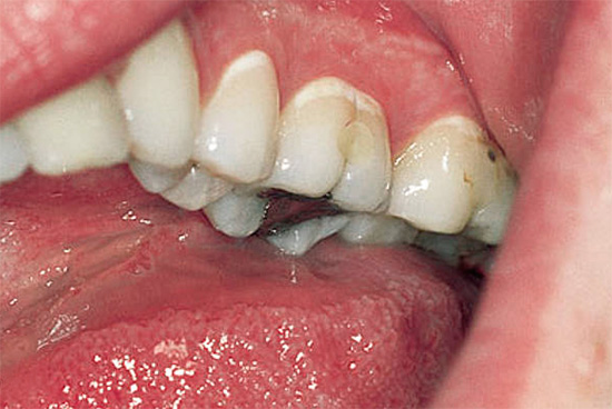 A fotografia mostra áreas brancas de esmalte desmineralizado na área cervical de vários dentes ao mesmo tempo.