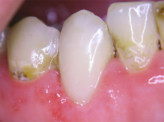 Um exemplo de cárie cervical superficial.