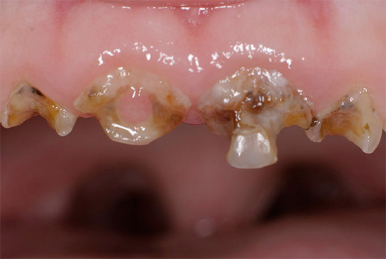Carie generalizzate di denti decidui in un bambino.