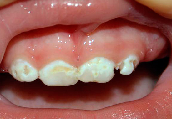 Un altro esempio di carie in bottiglia in un bambino: se non si inizia il trattamento dentale in tempo, in un breve periodo di tempo possono essere distrutti quasi completamente.