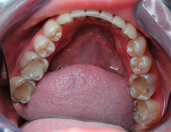 La carie può anche svilupparsi sotto otturazioni, nonché in punti in cui si adattano ai tessuti circostanti del dente.