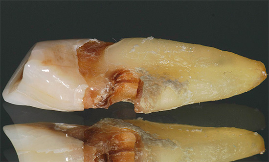 La carie radicolare, che spesso si sviluppa impercettibilmente sotto la gengiva, può alla fine portare alla perdita dei denti o alla necessità di rimuoverla.