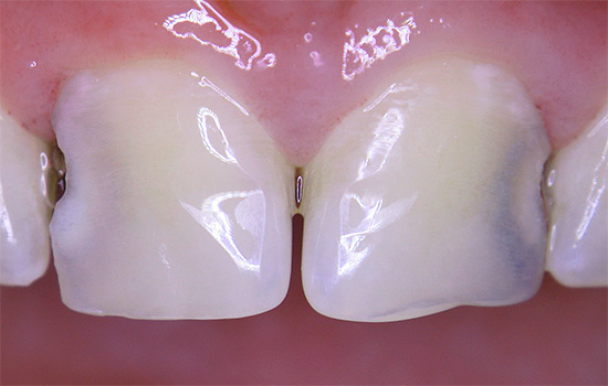 Tuttavia, man mano che la carie cavità tra i denti cresce, il problema alla fine diventa visibile ad occhio nudo.