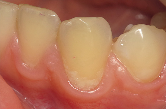 La foto mostra un'area biancastra di smalto demineralizzato nella zona cervicale del dente.