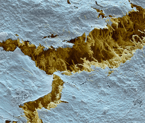 Questa immagine interessante mostra come i tessuti dei denti distrutti dalla carie sembrano al microscopio.