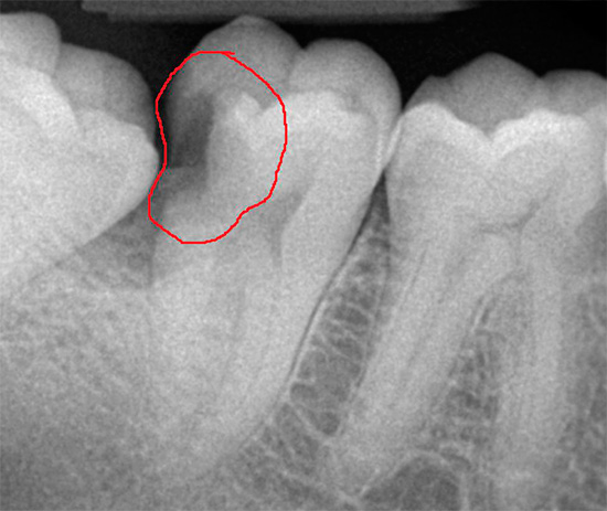 In questa radiografia è visibile una profonda cavità cariata sulla superficie di contatto del dente.