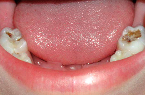 Con una carie così profonda sulle superfici masticatorie, si può facilmente verificare la scheggiatura di una parete dentale indebolita, per non parlare dell'elevato rischio di pulpite.