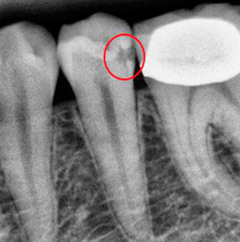 Le immagini radiografiche aiutano il medico a vedere quelle carie cavità che non si trovano durante un esame visivo di routine.