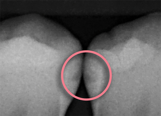 Carie prossimale in una radiografia