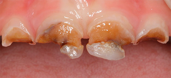 Nella forma acuta, la carie può distruggere i denti in un periodo di tempo molto breve ...