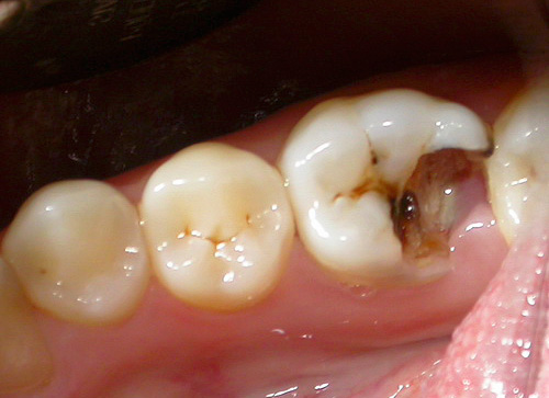 Sembra un dente con una profonda cavità cariata prima del trattamento
