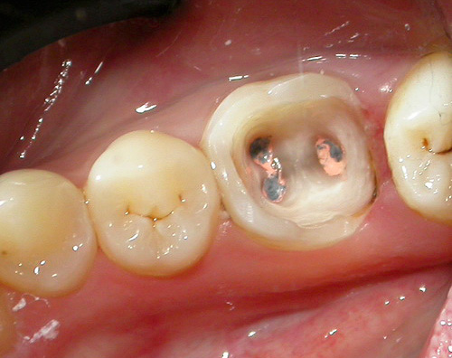 Il destino del dente dipende da molti aspetti dalla qualità del trattamento dei canali, quindi questa fase è molto responsabile.