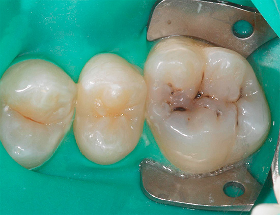La foto mostra la preparazione di un dente con carie da fessure per il trattamento: il tessuto interessato verrà asportato, dopo di che verrà sostituito con materiale di riempimento.