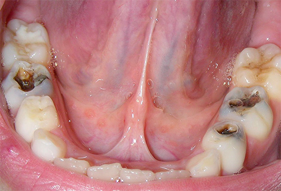 La fotografia mostra diversi denti affetti da carie profonde e questa condizione non è lontana dalla pulpite, quando il nervo dovrà essere rimosso durante il trattamento.