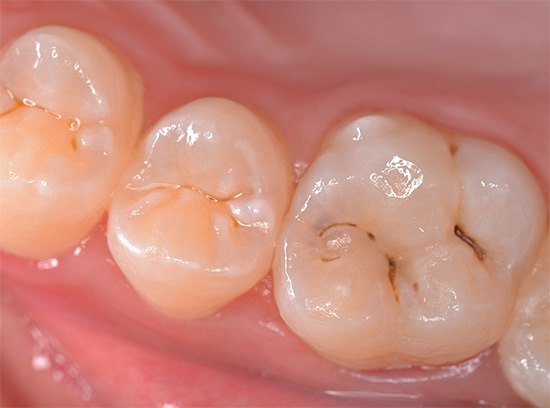 Molto spesso le ragadi sono affette da carie: depressioni naturali sulla sua superficie masticatoria.
