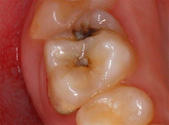 Dente cariato