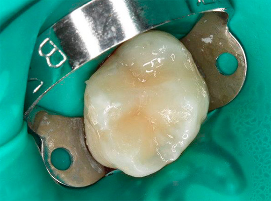 E sembra un dente già sigillato dopo il trattamento.