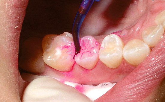 Di solito non è consigliabile trattare molti denti con un marker di carie contemporaneamente, poiché il tempo di esposizione della soluzione è piuttosto basso, quindi potresti non avere il tempo di risciacquare l'indicatore in tempo.