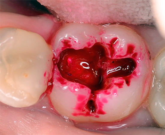 E qui il marcatore di carie viene utilizzato per macchiare la dentina: la dentina infetta dopo aver lavato via l'indicatore manterrà un colore brillante.