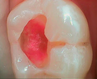 Quando si prepara un dente, la dentina colpita dalla carie viene rimossa fino a quando non smette di macchiare con un pennarello.