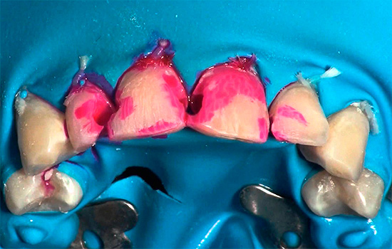 La tintura sintetica di fucsina colora i tessuti colpiti dalla carie in rosso vivo.