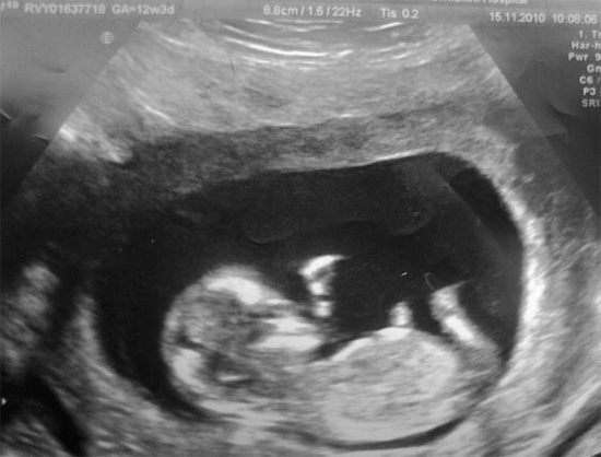Il mito secondo cui i microrganismi cariogeni sono in grado di penetrare la placenta nel feto è insolvente.