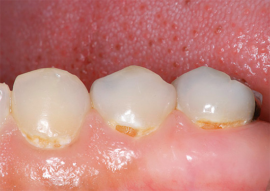A volte la carie durante la gravidanza può andare in forma acuta con un danno forte e simultaneo a molti denti contemporaneamente.