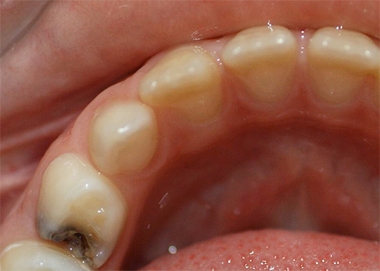 Con la carie profonda (nella foto), il processo patologico colpisce la dentina e può avvicinarsi alla camera della polpa del dente.