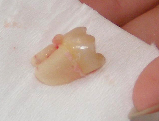 In assenza di un trattamento tempestivo, potrebbe essere necessario rimuovere il dente da latte, che a volte ha un grave effetto sulla formazione dell'occlusione nel bambino.