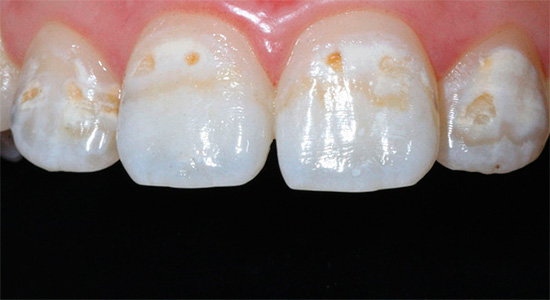 Se l'ulteriore perdita di componenti minerali a causa dello smalto dei denti non viene impedita, continuerà a collassare con l'approfondimento di carie cavità ...