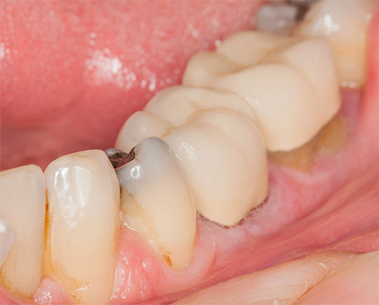Sebbene si creda ampiamente che la carie possa passare da un dente all'altro, ma questo è un malinteso