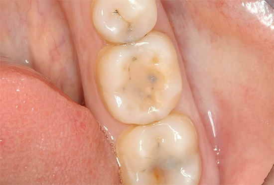 Oggi, in molti paesi, quasi ogni adulto ha segni di cari danni ai denti.