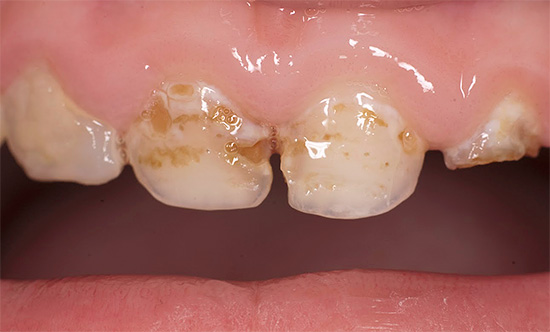 Muitas vezes, o tratamento de cárie nos dentes de leite em uma criança é significativamente mais complicado do que um procedimento semelhante em adultos ...