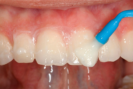 Se a cárie afeta apenas o esmalte de um dente de leite, o tratamento sem broca é frequentemente possível (por remineralização da terapia)