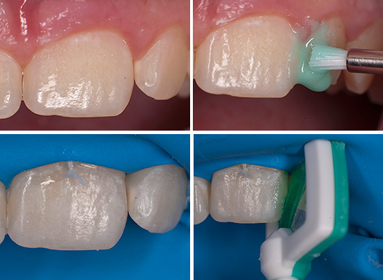 A imagem mostra o tratamento dentário usando a tecnologia Icon.
