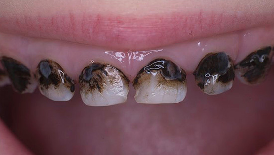 É assim que os dentes de leite cuidam da prateação - francamente, não é muito bonito.