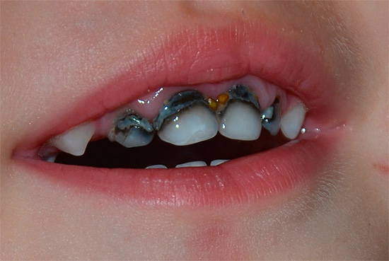 Além da desvantagem estética, a prateação dos dentes também tem uma eficácia geralmente baixa contra a cárie.